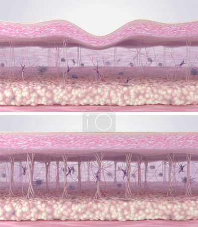 Aktivierung der Fibroblasten und Regeneration der Kollagenfasern in der extrazellulären Matrix der Haut. Querschnitt des Hautgewebes vor und nach der Behandlung der Anti-Aging-Faltenreduktion. 3D-Illustration