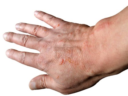 Chemische Verbrennung der Haut durch Bärenklau. Die Hand des Menschen hat an gefährlichen Verbrennungen gelitten, die als Kuh-Pastinaken oder Riesen-Kuh-Petersilie bekannt sind - die Handfläche ist auf weißem Hintergrund.