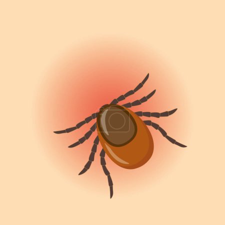 Ilustración de Garrapata pegado en la piel humana, riesgo de infección de Lyme y enfermedad transmitida por garrapatas-vector ilustración - Imagen libre de derechos