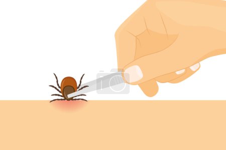 removing tick using tweezers, risk of infection of lyme and tick-borne disease- vector illustration