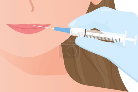 Lippen-Injektion zur Formsteigerung; Konzept Klinik für ästhetische Medizin - Vektor illustratio