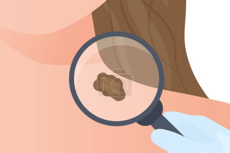 doctor checks mole under magnifier; melanoma skin cancer prevention- vector illustratio