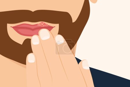 Ilustración de Infección por el virus del herpes simple en los labios masculinos - ilustración vectorial - Imagen libre de derechos