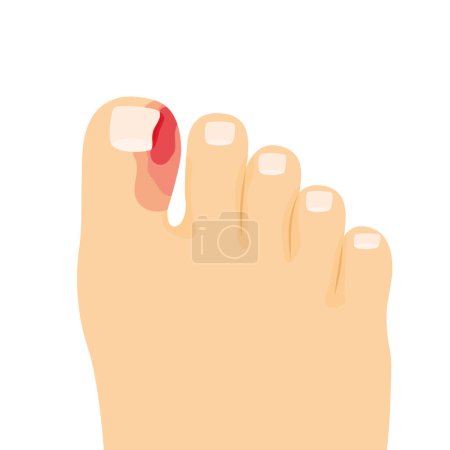 ingrown toenail, paronychia of the toe- vector illustration