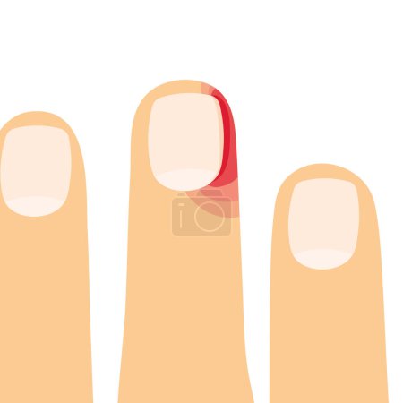 Illustration for Nail disease paronychia, inflammation of the skin around the nail- vector illustration - Royalty Free Image