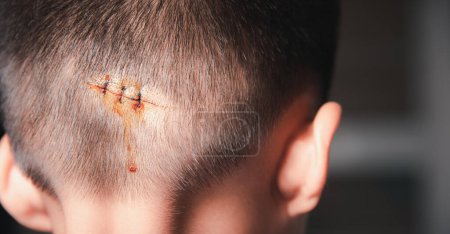 Photo for The lacerated sutured wound of kid back head which suture by nylon suture about 3 stitches at the emergency room of the hospital, Medical care of the surgery lesion on the head, children of Accident - Royalty Free Image