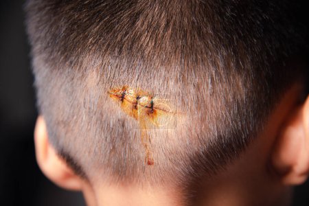Téléchargez les photos : La plaie suturée lacérée de la tête arrière de l'enfant qui suture par suture en nylon environ 3 points de suture à la salle d'urgence de l'hôpital, Soins médicaux de la lésion chirurgicale sur la tête, enfants d'accident - en image libre de droit