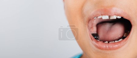 Foto de Una imagen dental de una corona de acero inoxidable una tapa de plata utilizada para restaurar los dientes dañados por caries o fracturas en los niños. Concepto de salud dental. Tapas de plata corona de acero para los dientes problema niño. - Imagen libre de derechos
