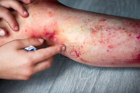 atopic dermatitis on the legs of a child treatment