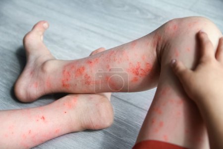 Foto de Dermatitis atópica en las piernas de un niño tratamiento - Imagen libre de derechos