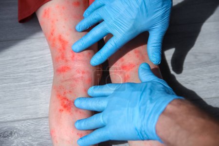 Téléchargez les photos : Dermatite atopique sur les jambes d'un traitement pour enfants - en image libre de droit