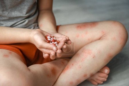 Photo for Atopic dermatitis on the legs of a child treatment - Royalty Free Image