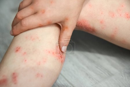 Téléchargez les photos : Dermatite atopique sur les jambes d'un traitement pour enfants - en image libre de droit