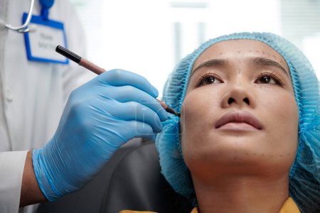 Foto de Mujer asiática consiguiendo su cara marcada antes de cirugía de lifting facial - Imagen libre de derechos