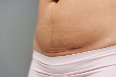 Photo for Close up belly of woman with a c-section scar of caesarean - Royalty Free Image