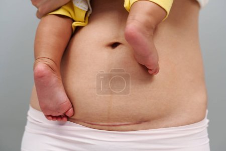 Bauch der Frau mit einer Kaiserschnitt-Narbe. Mutter hält ihr Baby