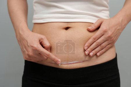 Photo for Woman putting healing cream in the c-section scar of cesarean - Royalty Free Image