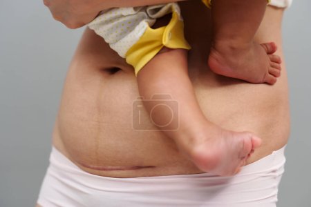 Photo for Belly of woman with a c-section scar of cesarean. mother holding her baby - Royalty Free Image