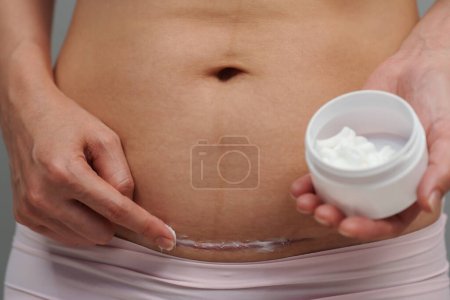 Photo for Woman putting healing cream in the c-section scar of cesarean - Royalty Free Image