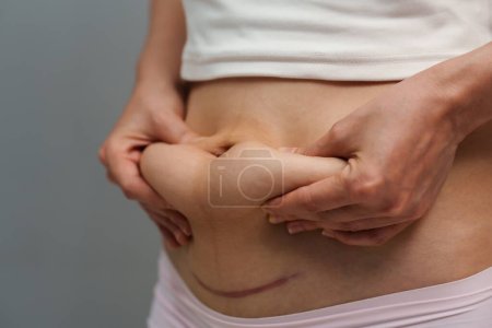 femme attrape et pince sa graisse du ventre post-partum et une cicatrice de césarienne 