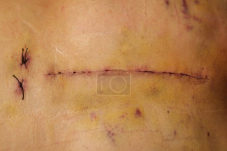 Photo for Wound from open heart surgery on the female body (Heart Valve Regurgitation) - Royalty Free Image