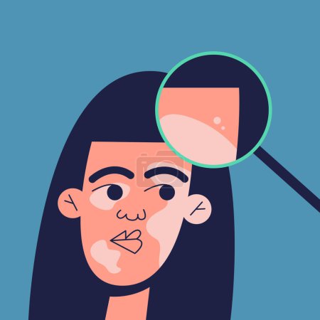 Illustration for A girl with problem skin at an appointment with a doctor who looks at her through a magnifying glass. World Vitiligo Day. Flat illustration of skin diseases. Medical concept.. - Royalty Free Image