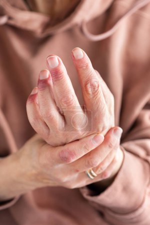 Téléchargez les photos : Gros plan des mains de femmes âgées atteintes de dermatite atopique, d'eczéma, de réaction allergique sur peau sèche - en image libre de droit