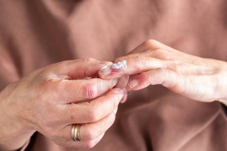 Téléchargez les photos : Femme âgée appliquant crème hydratante ou pommade à ses mains avec dermatite atopique, eczéma, réaction allergique sur la peau sèche - en image libre de droit