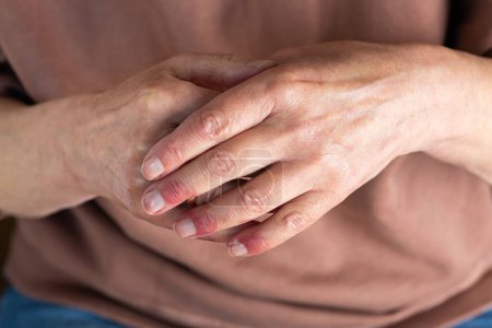 Foto de Primer plano de las manos de las mujeres mayores con dermatitis atópica, eccema, reacción alérgica en la piel seca - Imagen libre de derechos