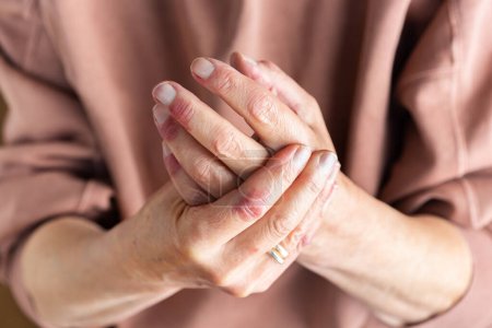 Foto de Close up of elder woman hands with atopic dermatitis, eczema, allergy reaction on dry skin - Imagen libre de derechos