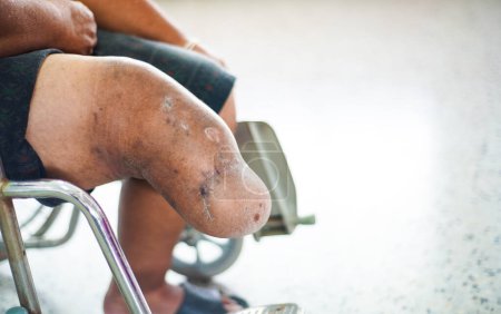 Téléchargez les photos : Dessous du patient amputé du genou assis sur fauteuil roulant - en image libre de droit