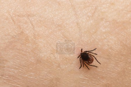 Tick bite on a person's skin