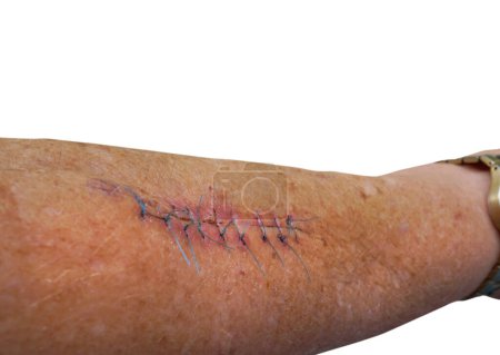Foto de Lunar melanoma quitó puntos de sutura en el brazo de una dama con un fondo blanco - Imagen libre de derechos