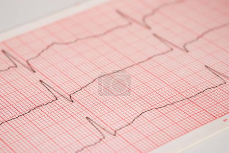 Téléchargez les photos : Rythme cardiaque ekg note sur papier Les médecins l'utilisent pour analyser les traitements des maladies cardiaques - en image libre de droit