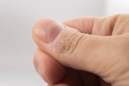 Foto de Uña estriada de un dedo pulgar de un hombre con crestas verticales sobre fondo blanco - Imagen libre de derechos