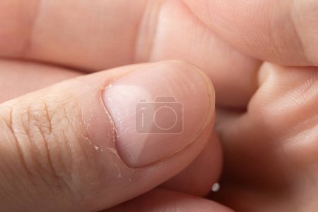 Ridged fingernails with vertical and horizontal ridges. Nails problems