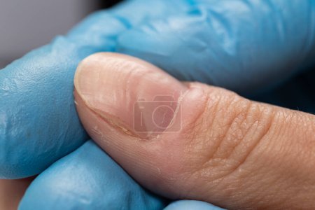 Doctor in gloves examining a ridged fingernails with vertical and horizontal ridges. Nails problems.
