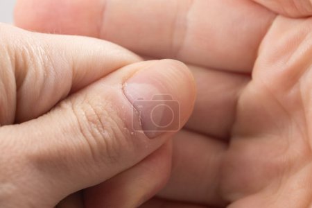 Ridged fingernail of a thumb finger of a man with horizontal ridges.