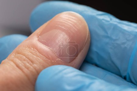 Docteur en gants examinant un ongle strié avec des crêtes verticales et horizontales. Problèmes de ongles.