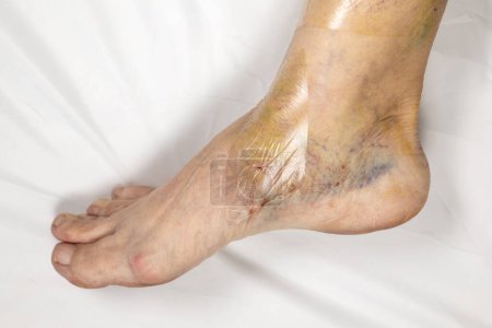 Scars on the lower leg of a woman after varicose vein. Hematomas from traces of a tight compression bandage.