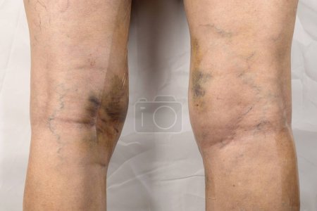 Woman legs after varicose vein surgery, with visible surgical sutures stitches and wounds on a leg. Curative treatment, aesthetic procedures, thrombosis prevention and senior health care concept.