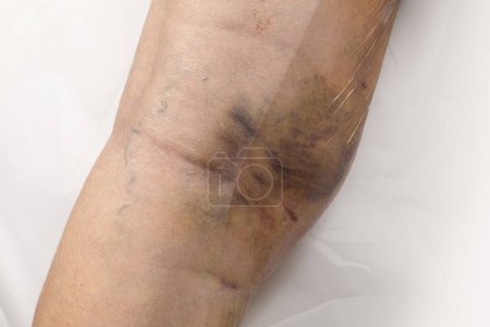 Téléchargez les photos : Cicatrices sur le bas de la jambe d'une femme après une varice. Hématomes provenant de traces d'un bandage de compression serré. - en image libre de droit