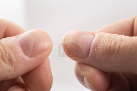 Foto de Uña estriada de un dedo pulgar de un hombre con crestas horizontales sobre fondo blanco - Imagen libre de derechos