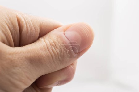 Ridged fingernail of a thumb finger of a man with horizontal ridges on white background