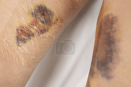 Cicatrices en la parte inferior de la pierna de una mujer después de una vena varicosa. Hematomas de rastros de vendaje apretado de compresión.