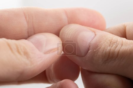 Ridged fingernail of a thumb finger of a man with horizontal ridges on white background