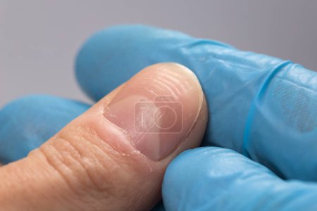 Médecin examinant un ongle strié avec des crêtes verticales et horizontales. Problèmes de ongles.