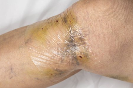 Cicatrices en la parte inferior de la pierna de una mujer después de una vena varicosa. Hematomas de rastros de vendaje apretado de compresión.