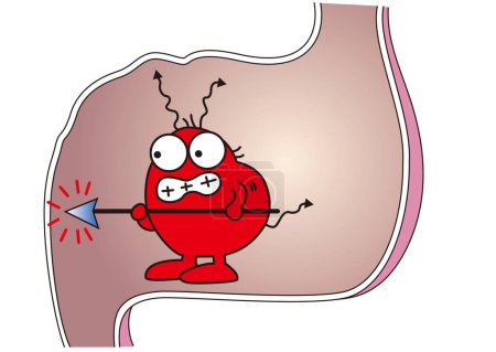 Téléchargez les illustrations : Mauvaises bactéries piquent la paroi de l'estomac et l'estomac fait mal - en licence libre de droit