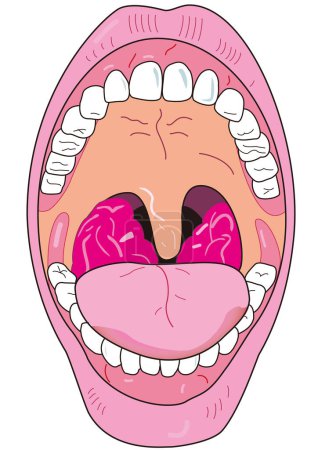 Téléchargez les illustrations : Amygdales agrandies peuvent être vus dans la bouche grande ouverte. - en licence libre de droit